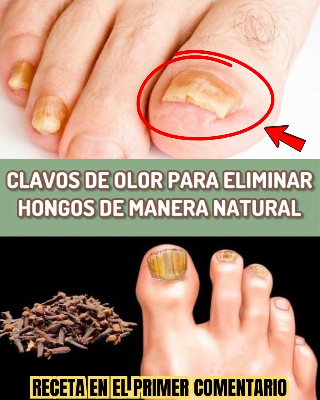 Hongos en las Uñas