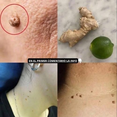 Tratamiento casero de jengibre y limón para verrugas