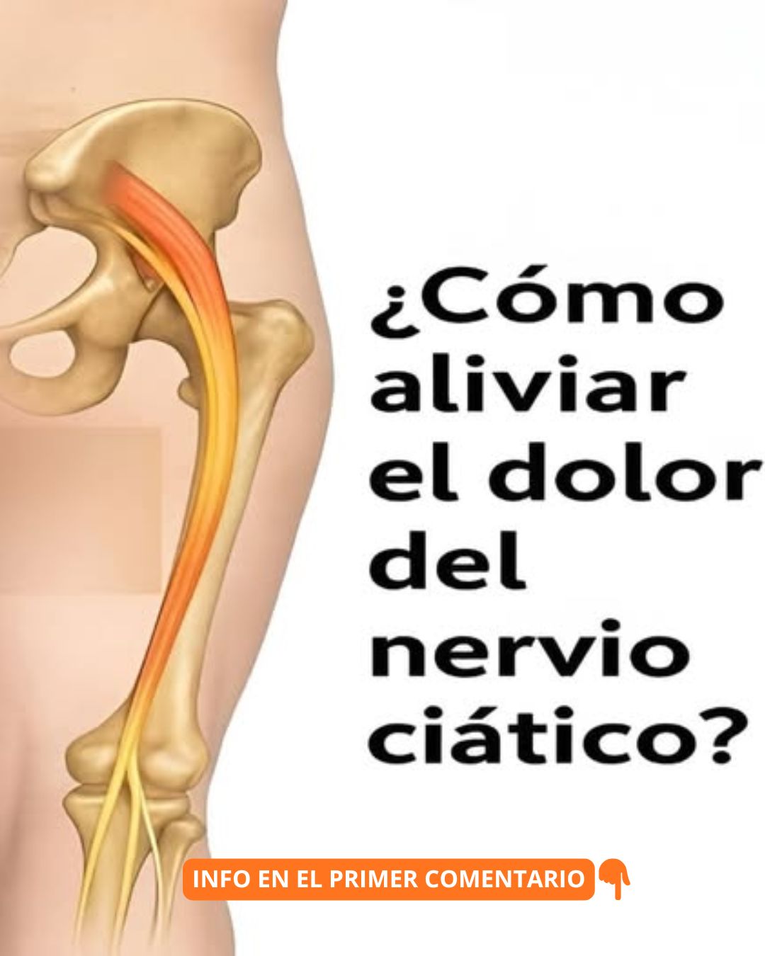 Ilustración del cuerpo humano resaltando el nervio ciático